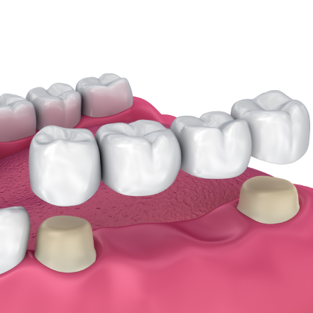 Dental Crowns & Bridges