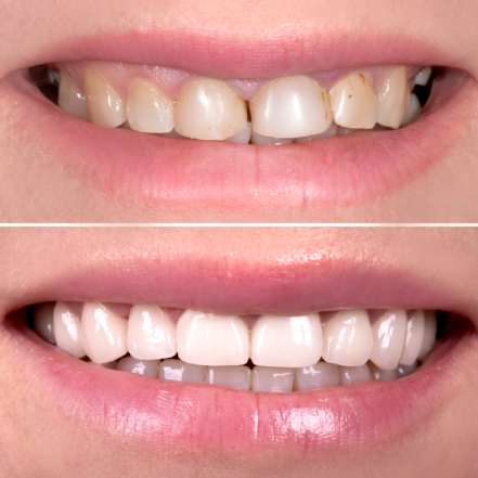 Dental Implant Restorations 