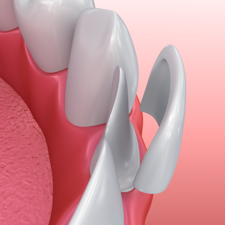 dental veneers