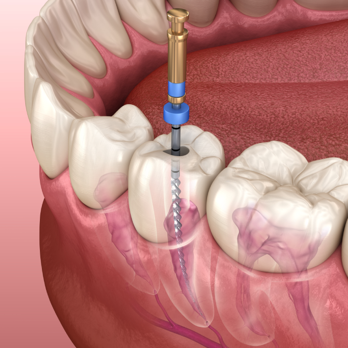 root canal