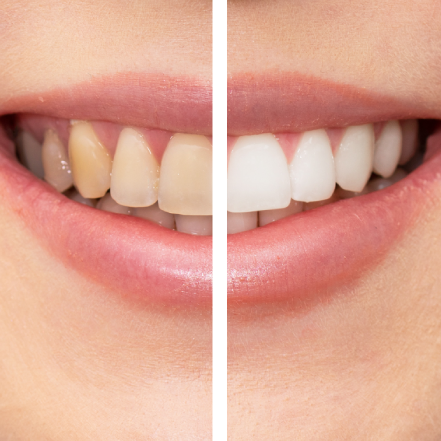 teeth whitening