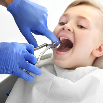 tooth extraction